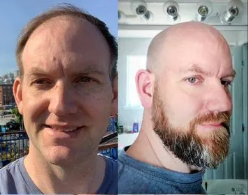 Bald before and after Jamie