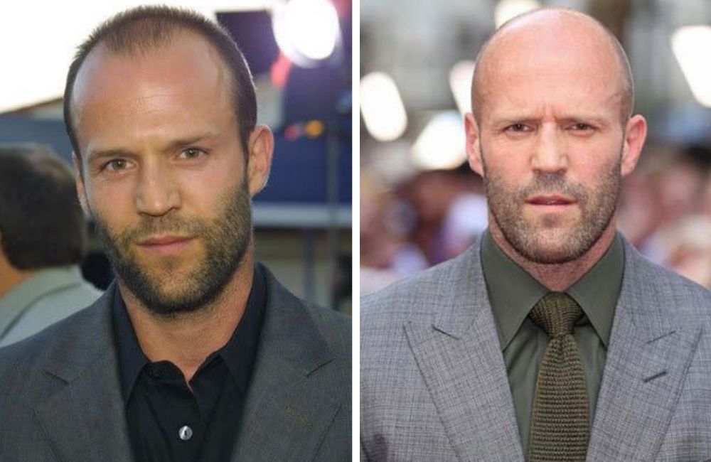 19 Bald Celebrities Before & After Embracing Baldness