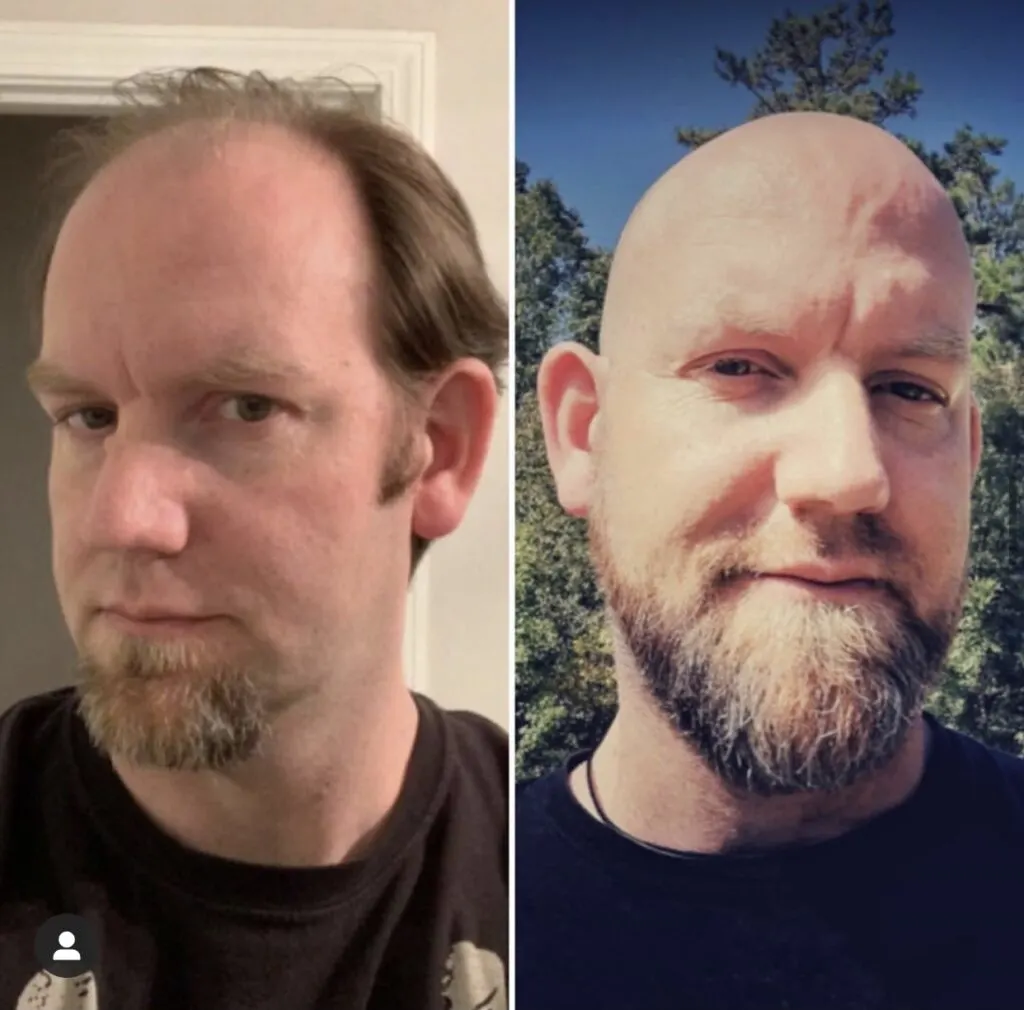 Bald before and after Jamie 1