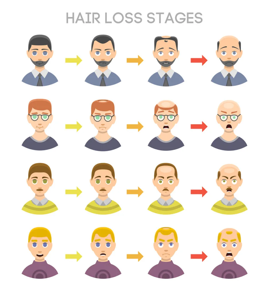 Receding Hairline Stages 