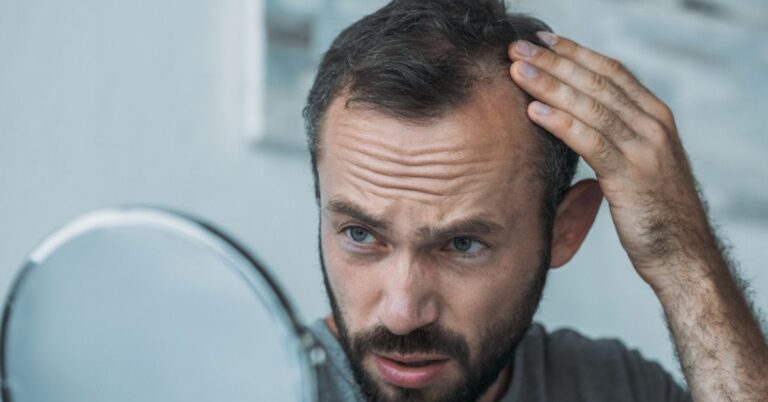 receding hairline