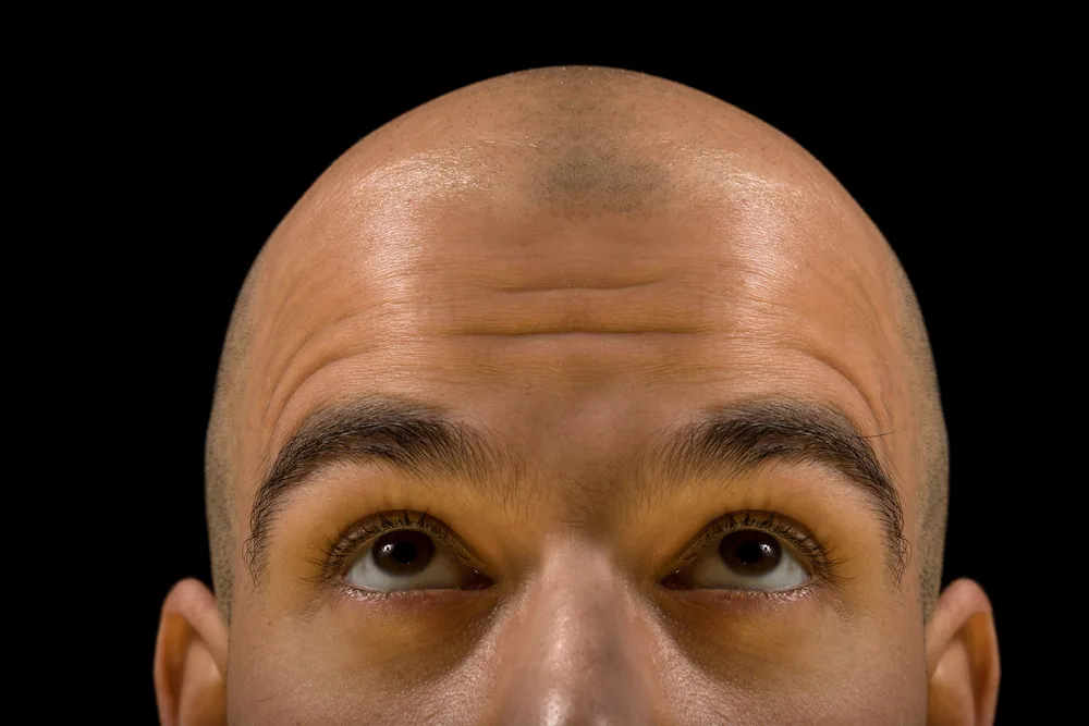 Dealing with hair loss 