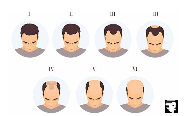 Balding Young - How To Deal With Balding In Your 20s