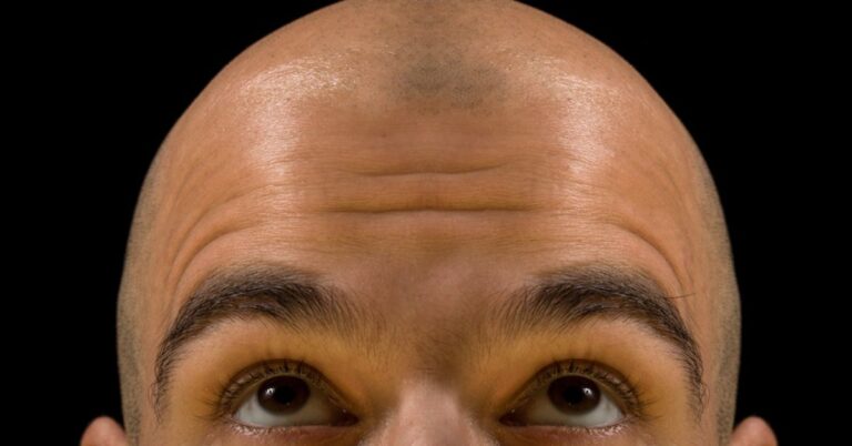Hair Loss In Men