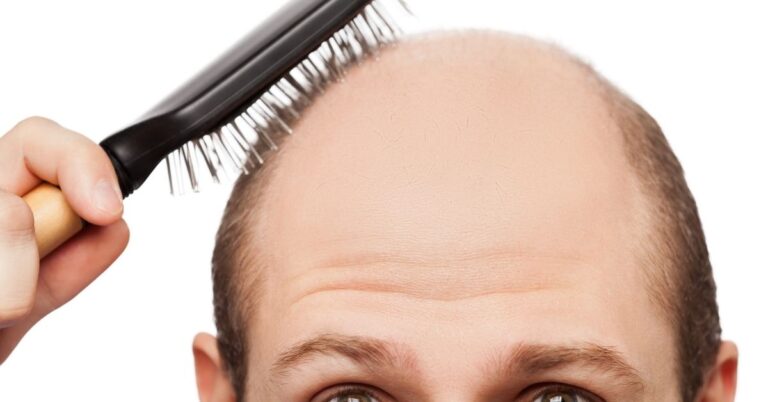 How To Overcome Hair Loss 2