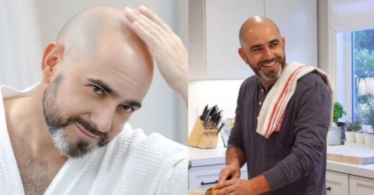 bald before