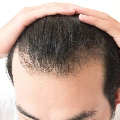 How To Stop Hair Loss In Men
