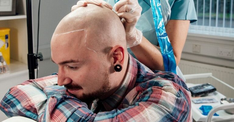 scalp micropigmentation